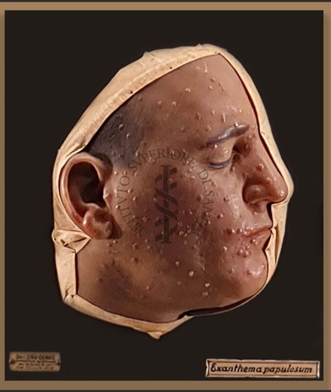 Modelli anatomici in cera Cera su legno raffigurante volto affetto da Exanthema Papulosum
