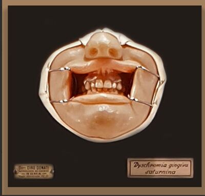 Modelli anatomici in cera CERA SU LEGNO RAFFIGURANTE VOLTO AFFETTO DA  " DYSCOMIA GINGIVA SATURNINA "