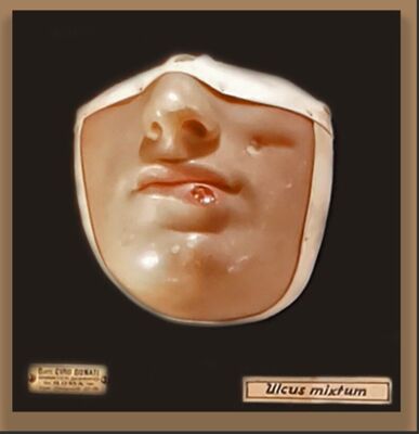 Modelli anatomici in cera CERA SU LEGNO RAFFIGURANTE VOLTO   AFFETTO DA  ULCUS MIXTUM