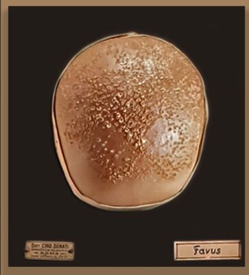 Modelli anatomici in cera CERA SU LEGNO CALOTTA CRANICA AFFETTA DA FAVUS