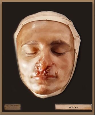 Modelli anatomici in cera Cera su legno raffigurante volto affetto da Morva