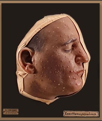 Modelli anatomici in cera Cera su legno raffigurante volto affetto da Exanthema Papulosum