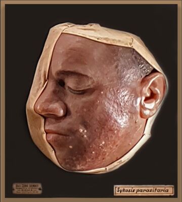 Modelli anatomici in cera Cera su legno raffigurante volto affetto da Sykosis parasitaria