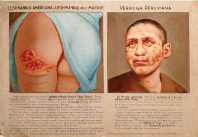 Disegno di Olzai Effetti cutanei dovuti alla Leishmaniosi americana e alla Verruga peruviana
